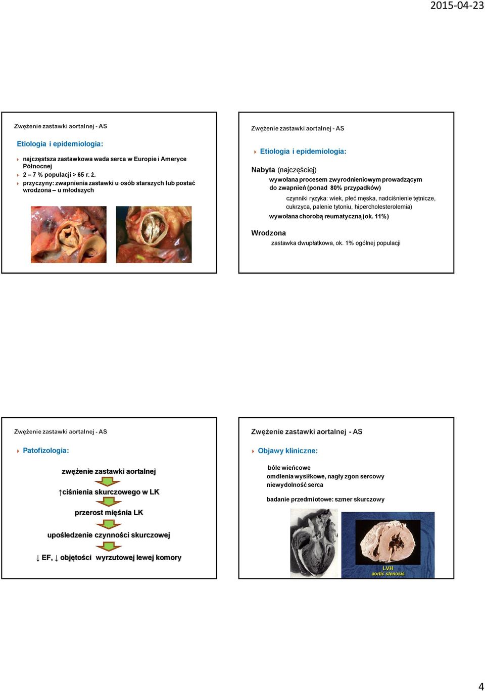 przypadków) czynniki ryzyka: wiek, płeć męska, nadciśnienie tętnicze, cukrzyca, palenie tytoniu, hipercholesterolemia) wywołana chorobą reumatyczną (ok. 11%) Wrodzona zastawka dwupłatkowa, ok.