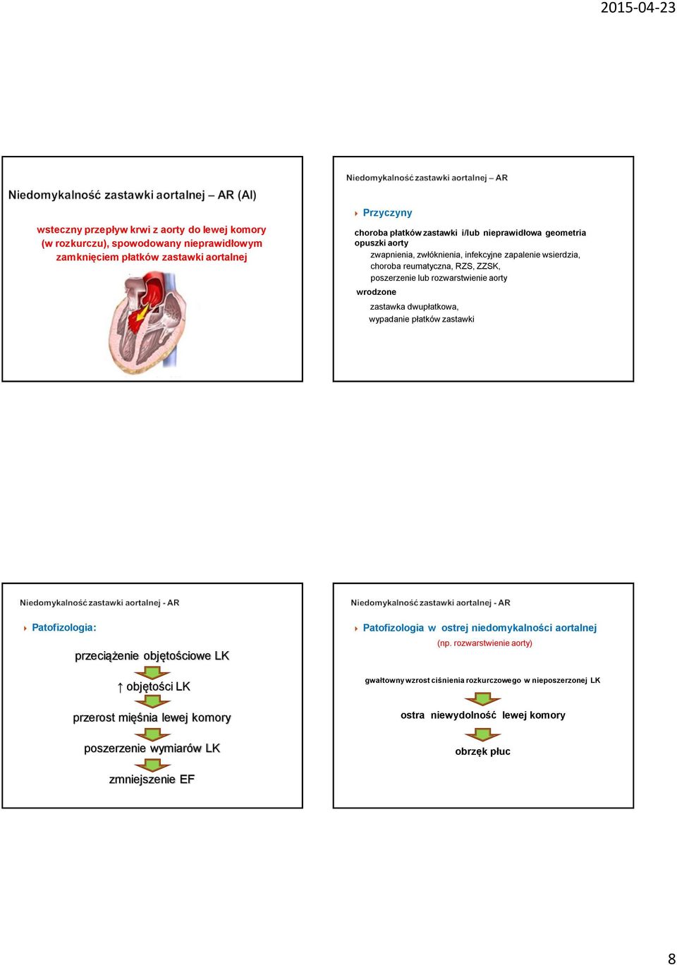 zastawka dwupłatkowa, wypadanie płatków zastawki Patofizologia: przeciążenie objętościowe LK Patofizologia w ostrej niedomykalności aortalnej (np.