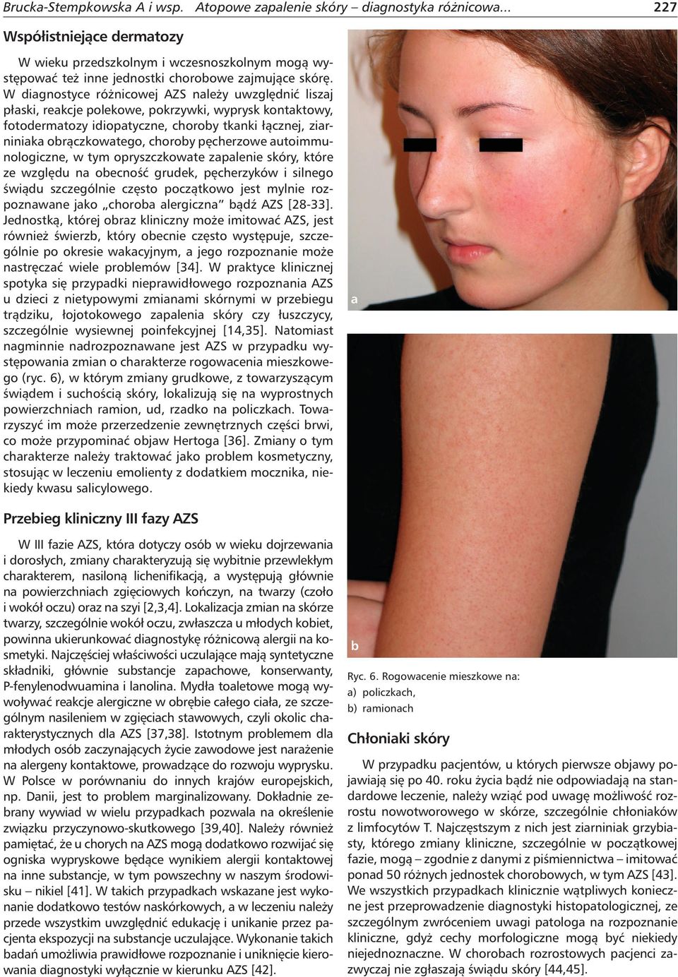 W diagnostyce różnicowej AZS należy uwzględnić liszaj płaski, reakcje polekowe, pokrzywki, wyprysk kontaktowy, fotodermatozy idiopatyczne, choroby tkanki łącznej, ziarniniaka obrączkowatego, choroby