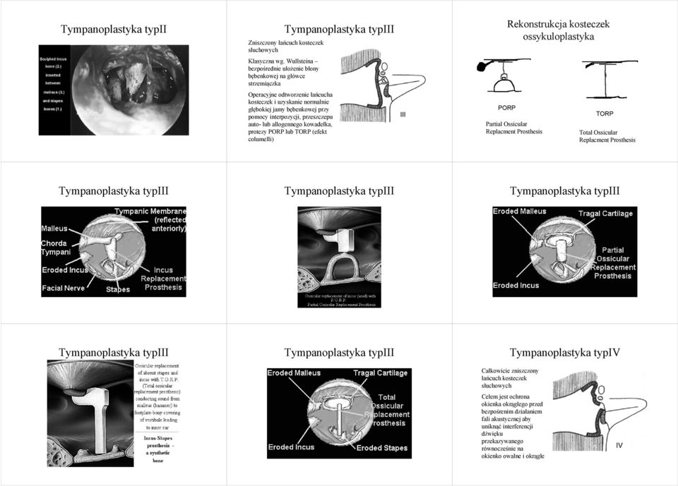 przeszczepu auto- lub allogennego kowadełka, protezy PORP lub TORP (efekt columelli) PORP Rekonstrukcja kosteczek ossykuloplastyka Partial Ossicular Replacment Prosthesis TORP Total Ossicular