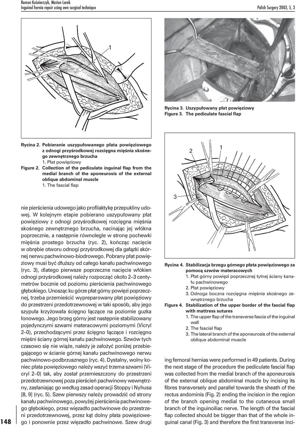 Collection of the pediculate inguinal flap from the medial branch of the aponeurosis of the external oblique abdominal muscle 1.