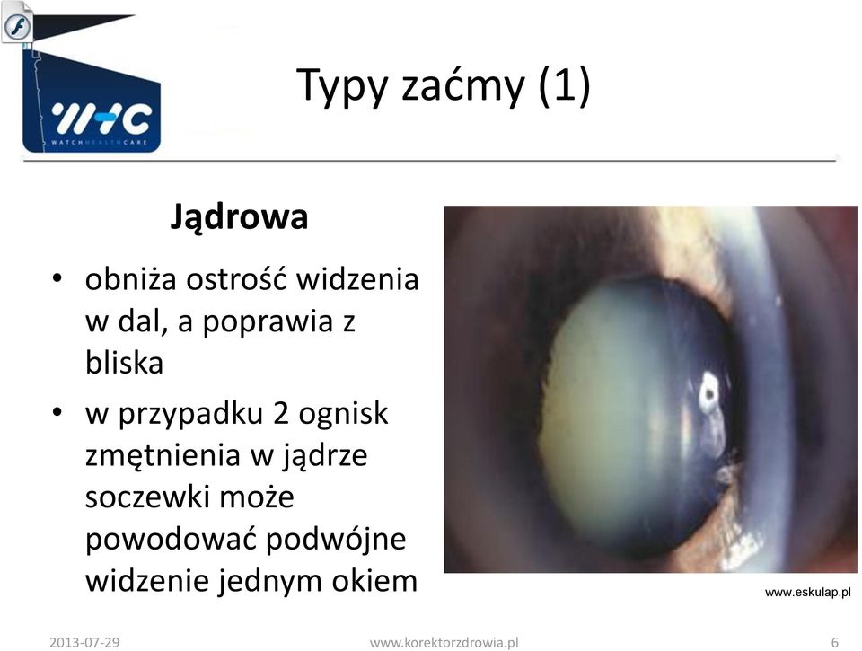 zmętnienia w jądrze soczewki może powodować podwójne