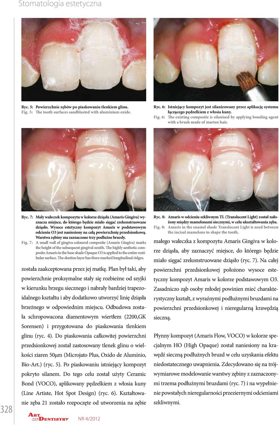 328 Ryc. 7: Fig. 7: Mały wałeczek kompozytu w kolorze dziąsła (Amaris Gingiva) wyznacza miejsce, do którego będzie miało sięgać zrekonstruowane dziąsło.