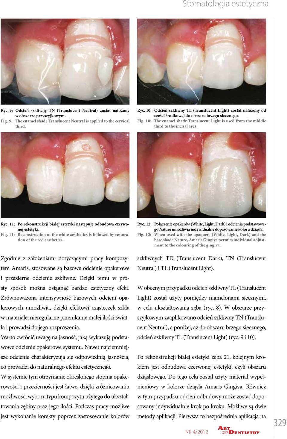 11: Fig. 11: Po rekonstrukcji białej estetyki następuje odbudowa czerwonej estetyki. Reconstruction of the white aesthetics is followed by restoration of the red aesthetics.