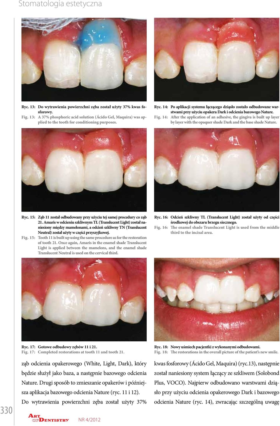 After the application of an adhesive, the gingiva is built up layer by layer with the opaquer shade Dark and the base shade Nature. Ryc. 15: Fig.