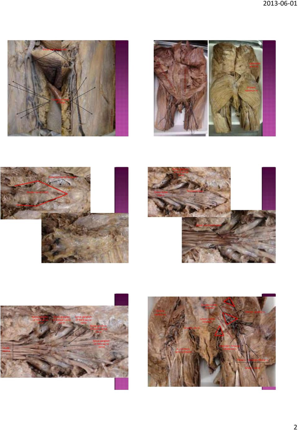 arachnoid mater Cauda equina of first sacral of second sacral of third sacral of fourth sacral of fitth sacral Gluteus medius