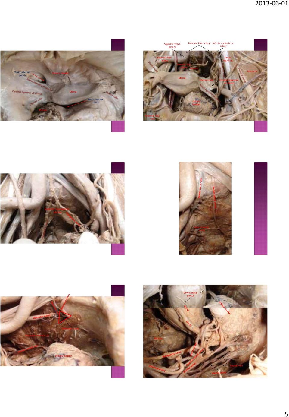 Uterus Recto-uterine pouch Urinary bladder Rectum External iliac vein Superior hypogastric plexus