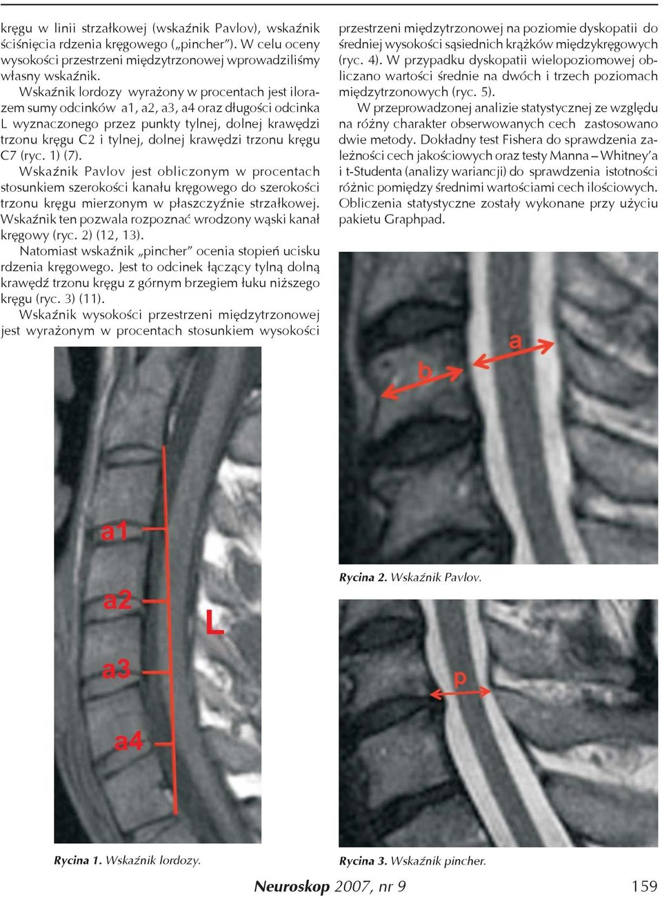 trzonu kręgu C7 (ryc. 1) (7). Wskaźnik Pavlov jest obliczonym w procentach stosunkiem szerokości kanału kręgowego do szerokości trzonu kręgu mierzonym w płaszczyźnie strzałkowej.