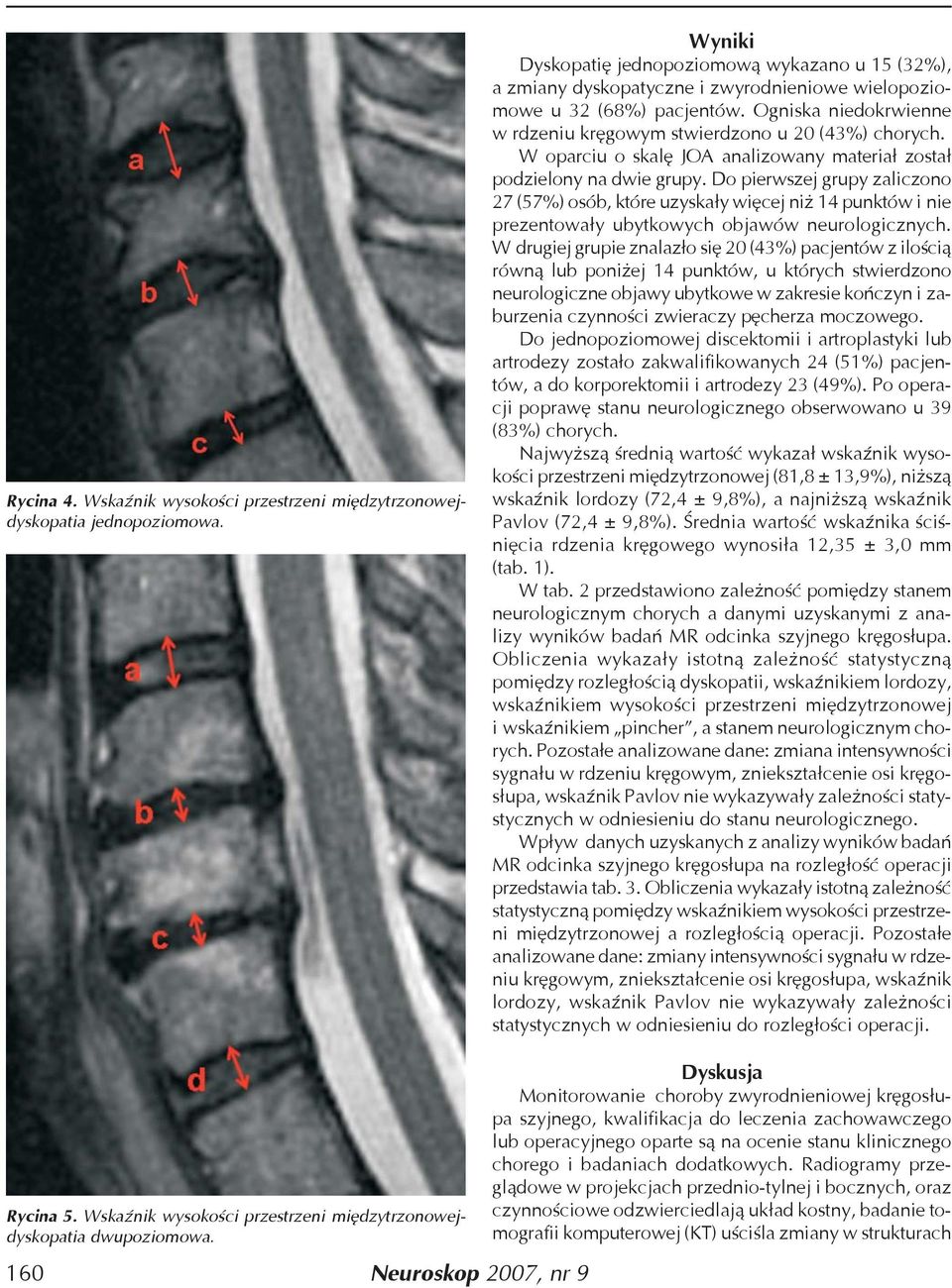 Ogniska niedokrwienne w rdzeniu kręgowym stwierdzono u 20 (43%) chorych. W oparciu o skalę JOA analizowany materiał został podzielony na dwie grupy.