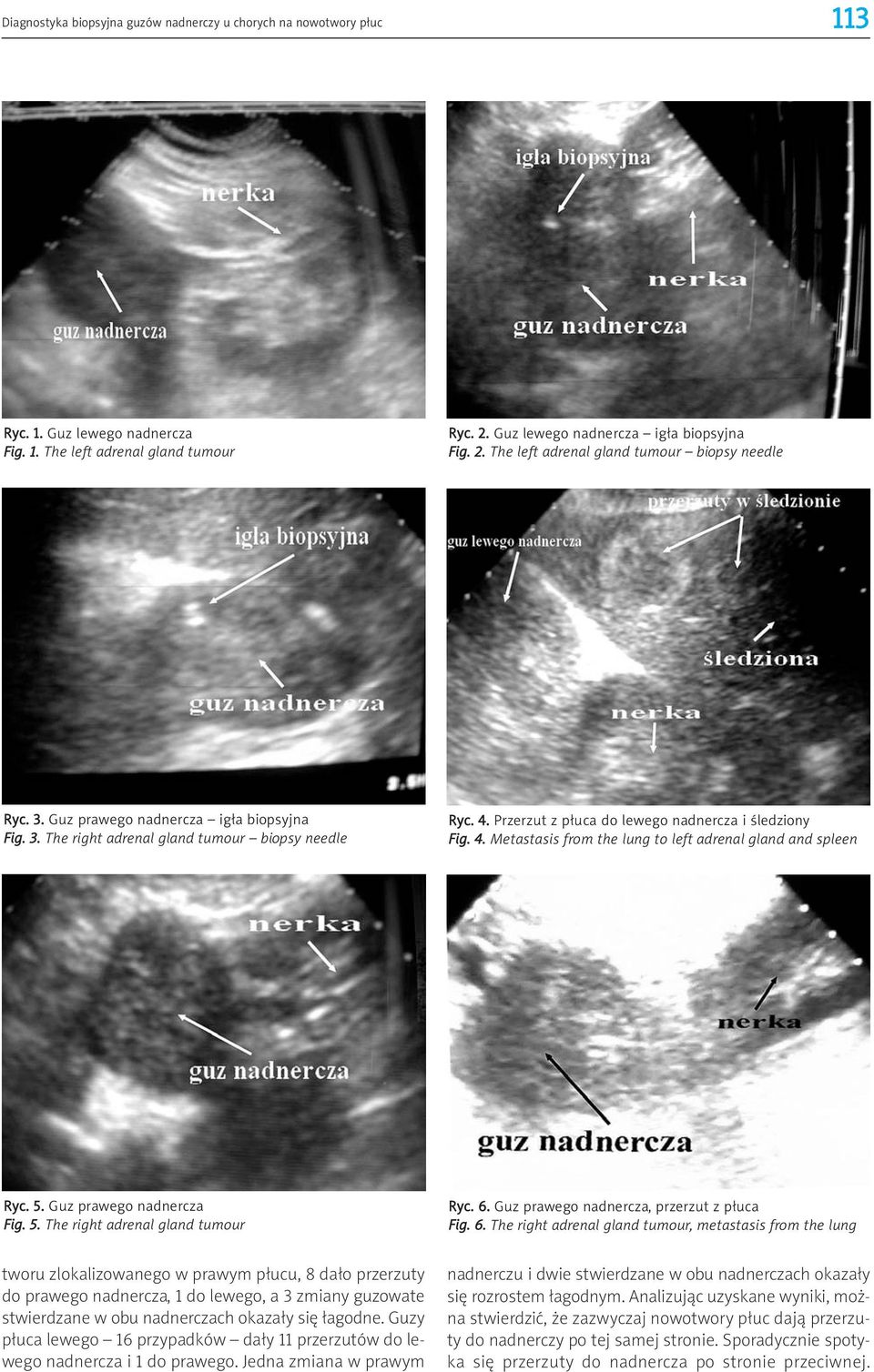 5. Guz prawego nadnercza Fig. 5. The right adrenal gland tumour Ryc. 6.