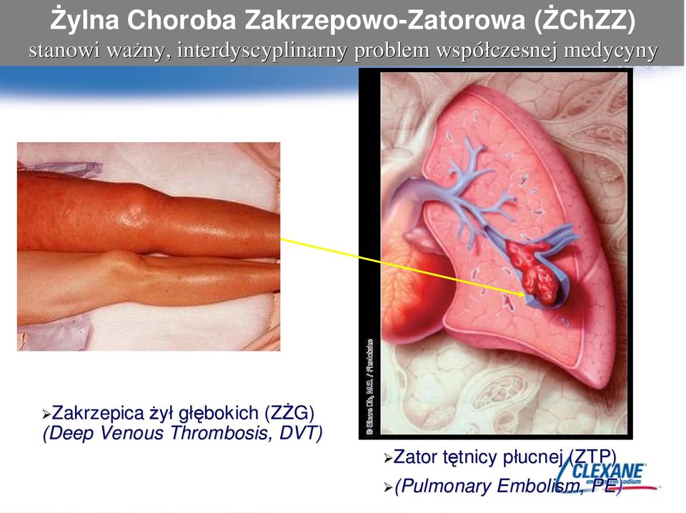 Zakrzepica żył głębokich (ZŻG) (Deep Venous Thrombosis,