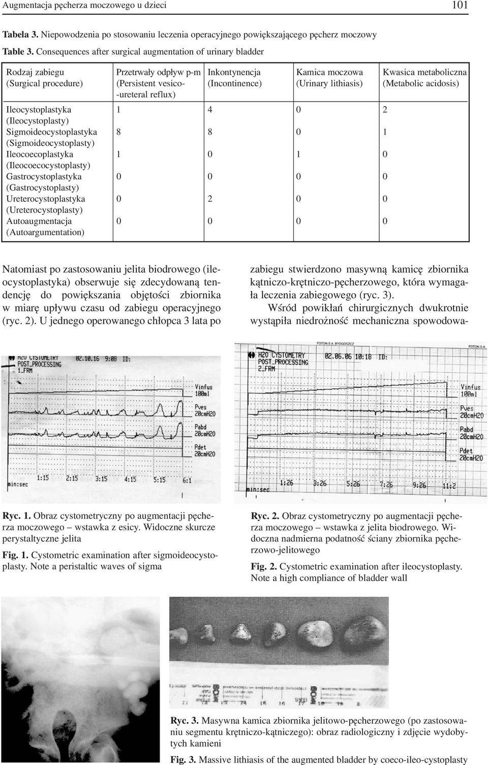 (Incontinence) (Urinary lithiasis) (Metabolic acidosis) ureteral reflux) Ileocystoplastyka 1 4 0 2 (Ileocystoplasty) Sigmoideocystoplastyka 8 8 0 1 (Sigmoideocystoplasty) Ileocoecoplastyka 1 0 1 0