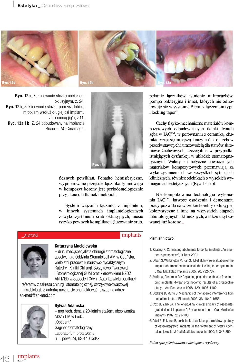 Ponadto hemisferyczne, wypolerowane przejście łącznika tytanowego w kompozyt korony jest periodontologicznie przyjazne dla tkanek miękkich.