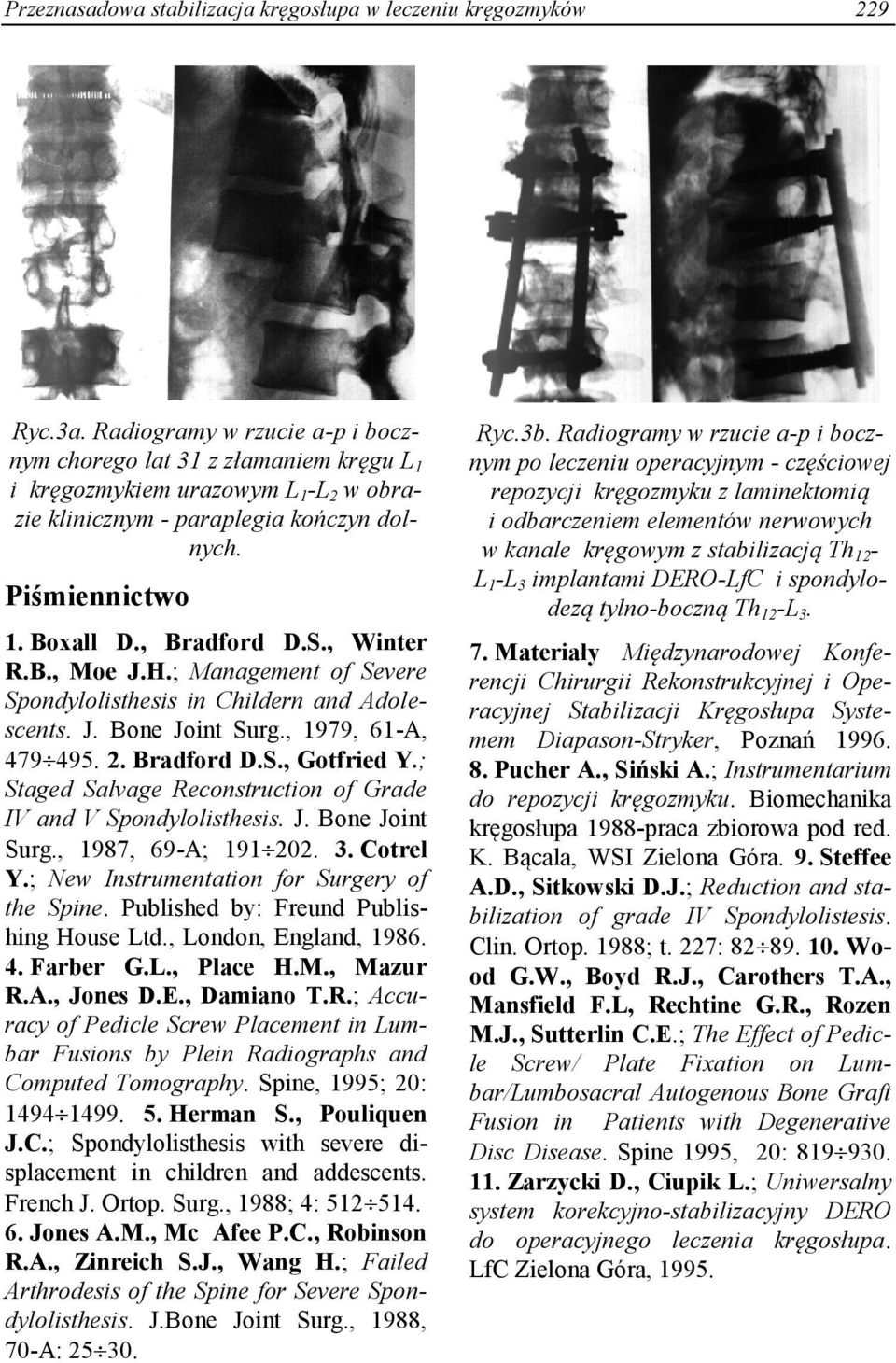 , Winter R.B., Moe J.H.; Management of Severe Spondylolisthesis in Childern and Adolescents. J. Bone Joint Surg., 1979, 61-A, 479 495. 2. Bradford D.S., Gotfried Y.