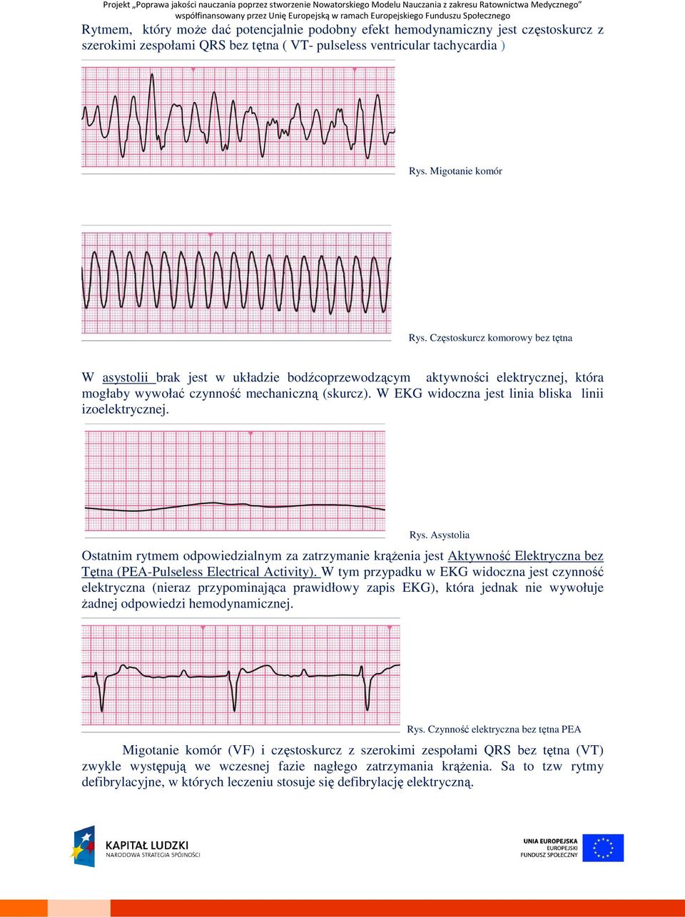 W EKG widoczna jest linia bliska linii izoelektrycznej. Rys. Asystolia Ostatnim rytmem odpowiedzialnym za zatrzymanie krążenia jest Aktywność Elektryczna bez Tętna (PEA-Pulseless Electrical Activity).