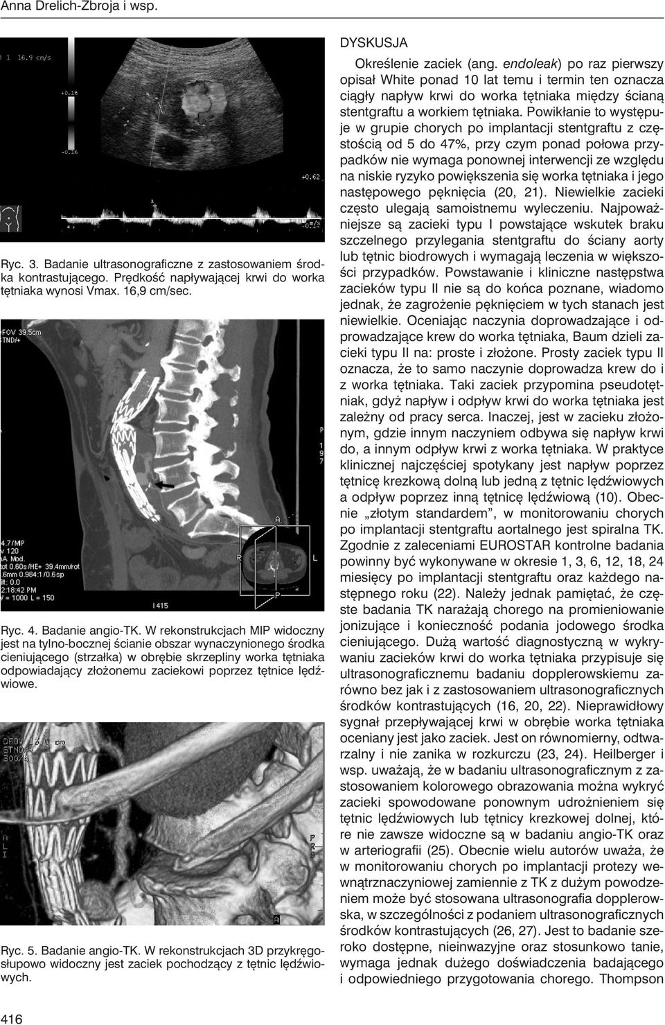 lędźwiowe. Ryc. 5. Badanie angio-tk. W rekonstrukcjach 3D przykręgosłupowo widoczny jest zaciek pochodzący z tętnic lędźwiowych. DYSKUSJA Określenie zaciek (ang.