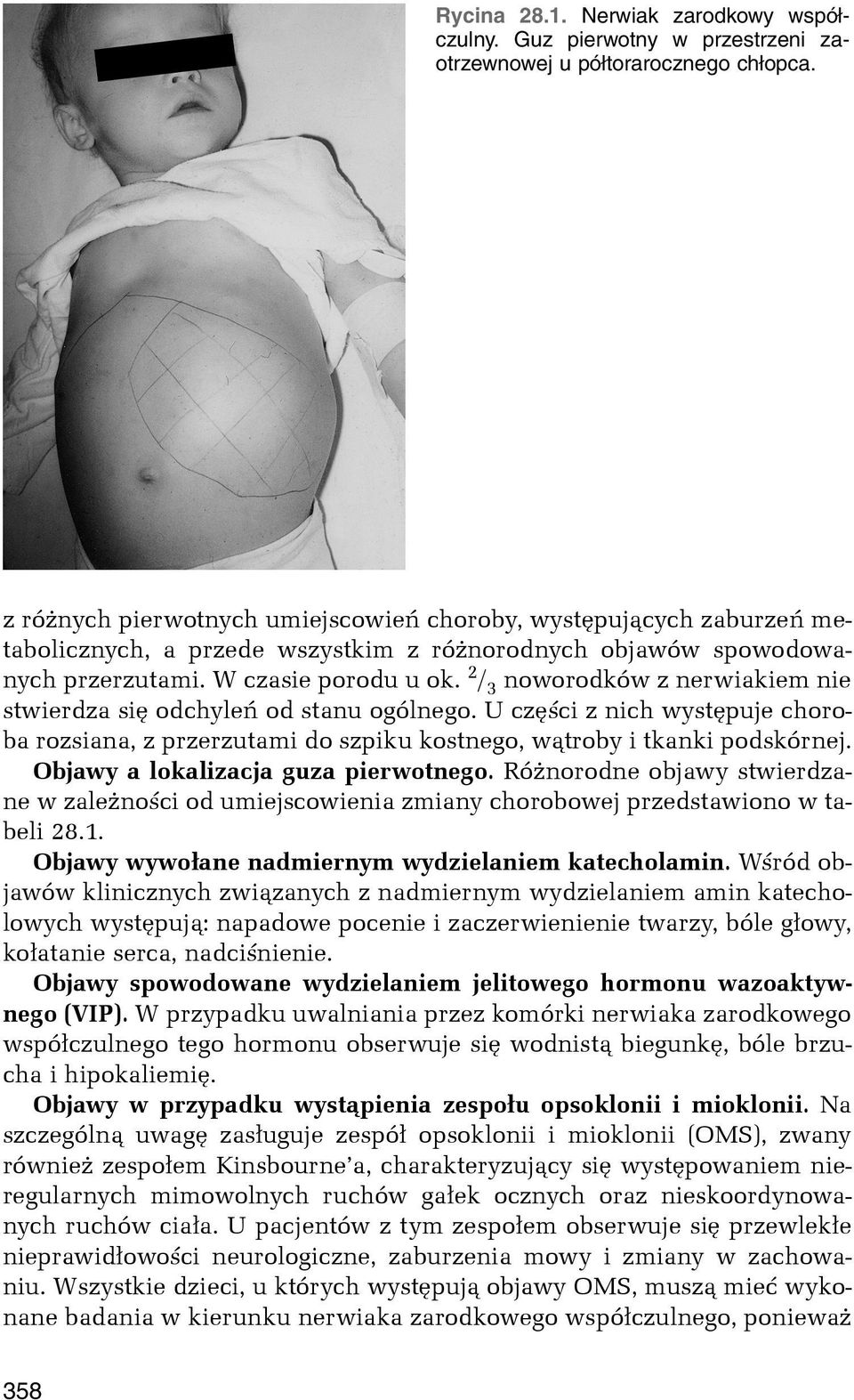 2 / 3 noworodków z nerwiakiem nie stwierdza siê odchyleñ od stanu ogólnego. U czêœci z nich wystêpuje choroba rozsiana, z przerzutami do szpiku kostnego, w¹troby i tkanki podskórnej.