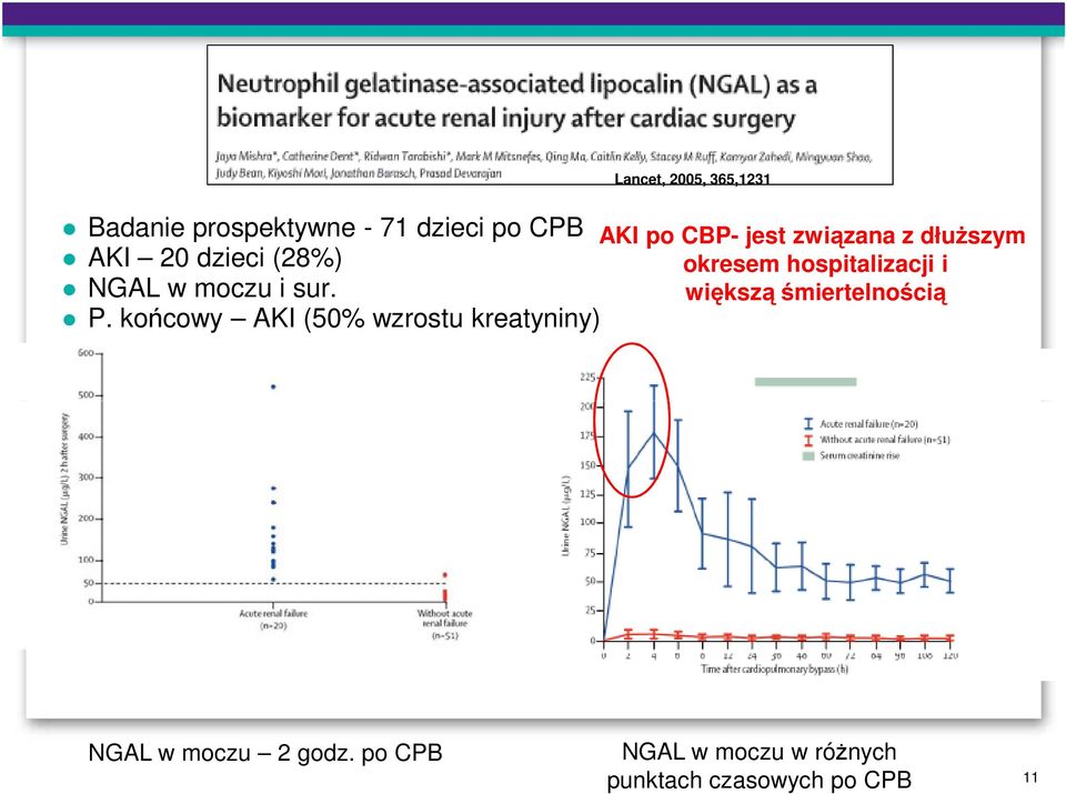 końcowy AKI (50% wzrostu kreatyniny) Lancet, 2005, 365,1231 AKI po CBP- jest