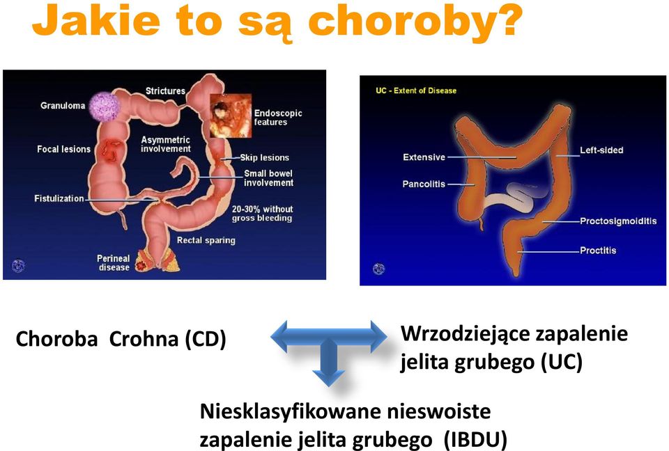 zapalenie jelita grubego (UC)