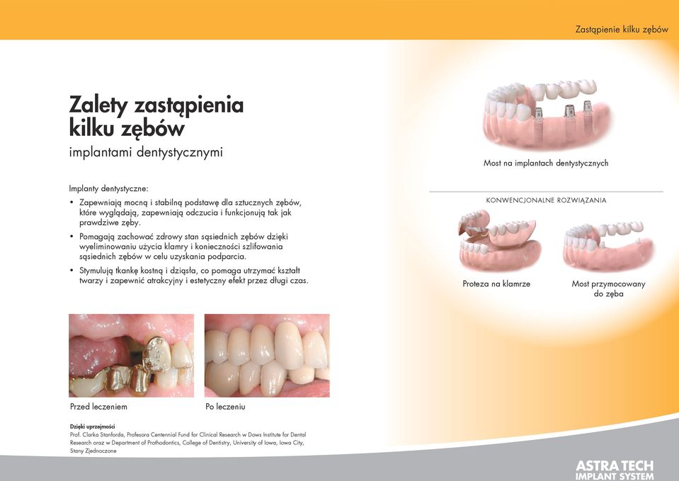 KONWENCJONALNE ROZWIĄZANIA Pomagają zachować zdrowy stan sąsiednich zębów dzięki wyeliminowaniu użycia klamry i konieczności szlifowania sąsiednich zębów w celu uzyskania podparcia.