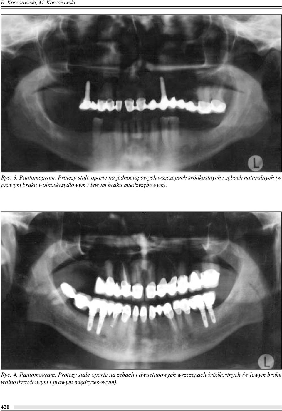 prawym braku wolnoskrzydłowym i lewym braku międzyzębowym). Ryc. 4. Pantomogram.