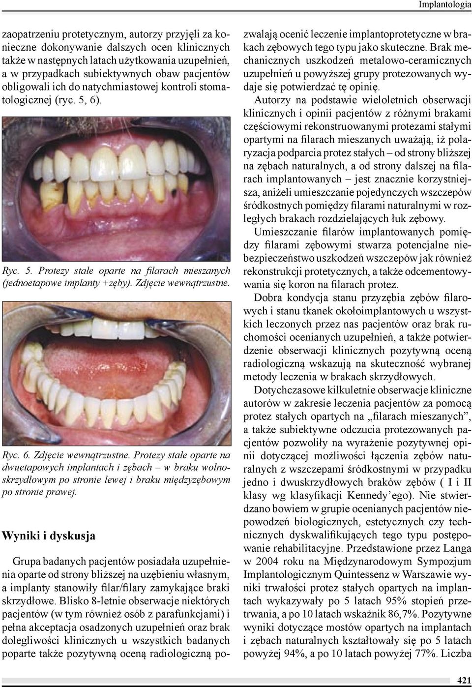 Ryc. 6. Zdjęcie wewnątrzustne. Protezy stałe oparte na dwuetapowych implantach i zębach w braku wolnoskrzydłowym po stronie lewej i braku międzyzębowym po stronie prawej.