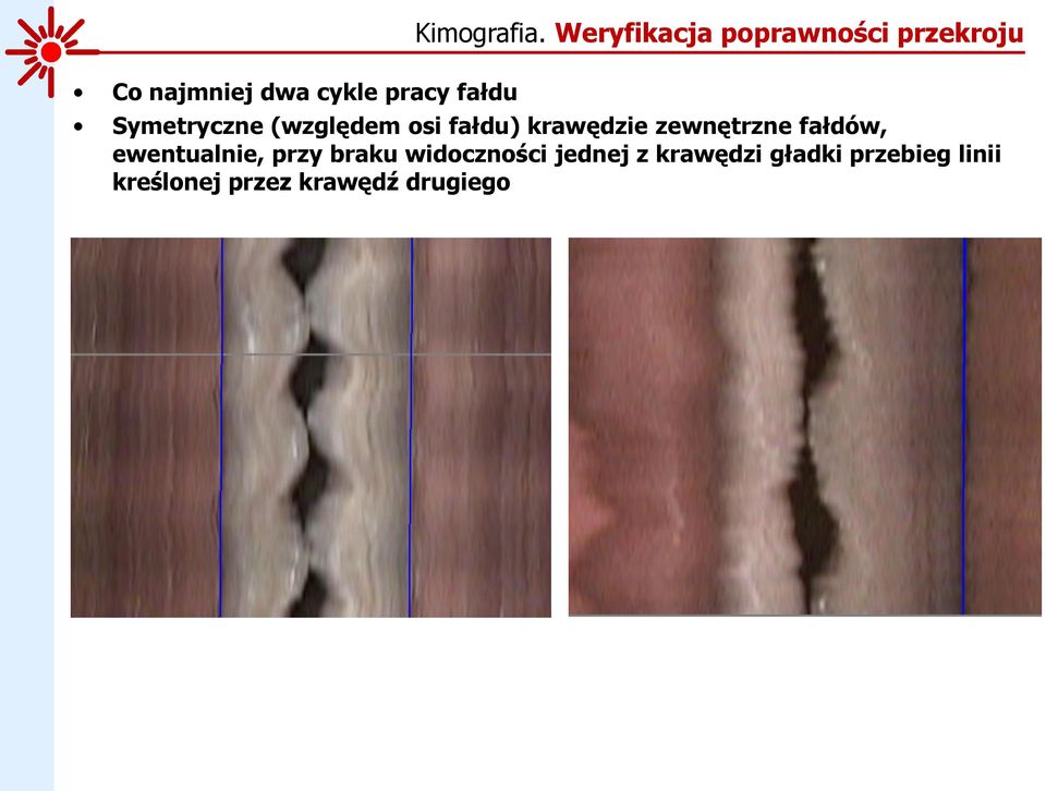 fałdu) krawędzie zewnętrzne fałdów, ewentualnie, przy braku