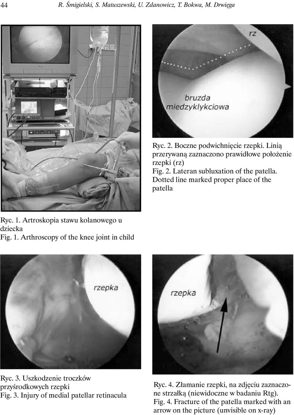 1. Artroskopia stawu kolanowego u dziecka Fig. 1. Arthroscopy of the knee joint in child Ryc. 3. Uszkodzenie troczków przyśrodkowych rzepki Fig. 3. Injury of medial patellar retinacula Ryc.