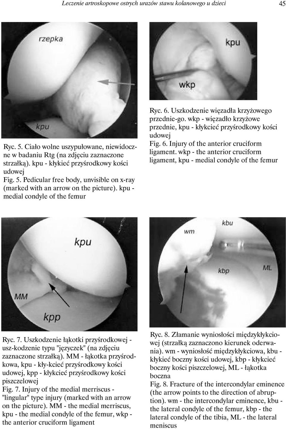 Uszkodzenie więzadła krzyżowego przednie-go. wkp - więzadło krzyżowe przednie, kpu - kłykcieć przyśrodkowy kości udowej Fig. 6. Injury of the anterior cruciform ligament.