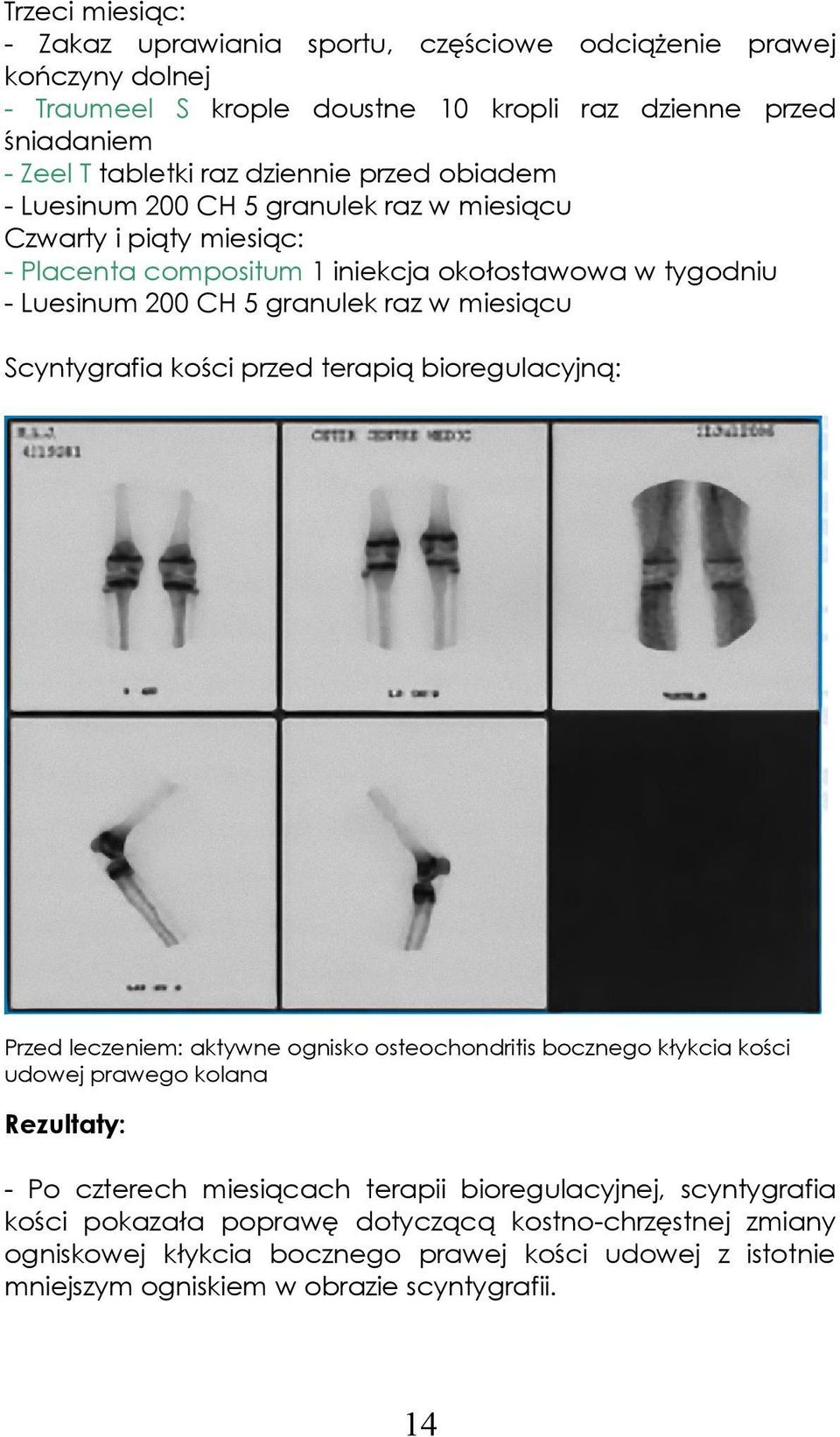 Scyntygrafia kości przed terapią bioregulacyjną: Przed leczeniem: aktywne ognisko osteochondritis bocznego kłykcia kości udowej prawego kolana Rezultaty: - Po czterech miesiącach terapii