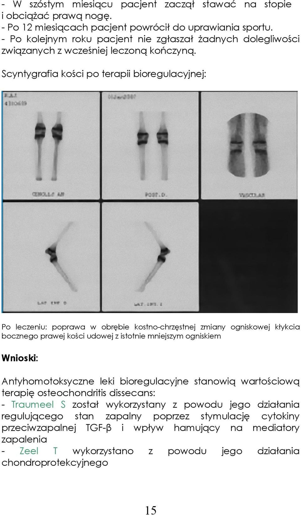 Scyntygrafia kości po terapii bioregulacyjnej: Po leczeniu: poprawa w obrębie kostno-chrzęstnej zmiany ogniskowej kłykcia bocznego prawej kości udowej z istotnie mniejszym ogniskiem Wnioski: