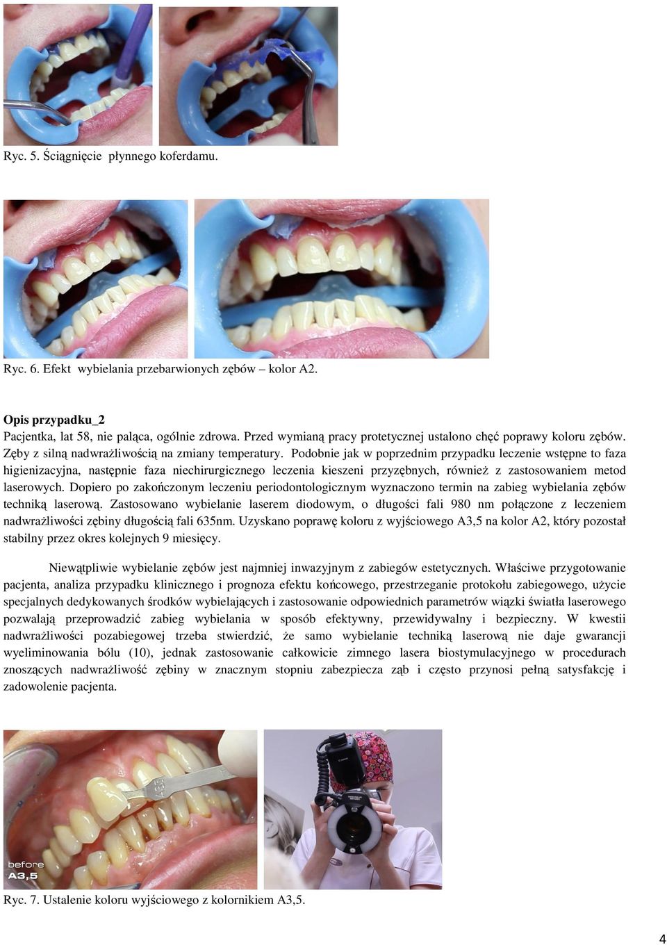 Podobnie jak w poprzednim przypadku leczenie wstępne to faza higienizacyjna, następnie faza niechirurgicznego leczenia kieszeni przyzębnych, również z zastosowaniem metod laserowych.