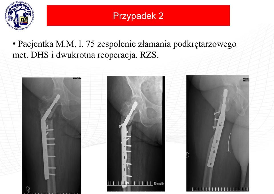 podkrętarzowego met.