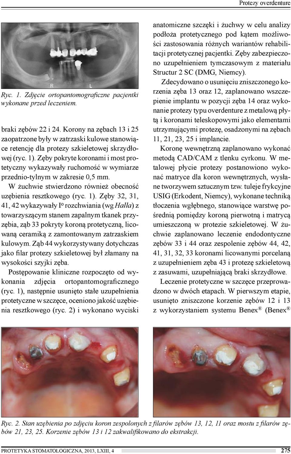 Zęby pokryte koronami i most protetyczny wykazywały ruchomość w wymiarze przednio-tylnym w zakresie 0,5 mm. W żuchwie stwierdzono również obecność uzębienia resztkowego (ryc. 1).