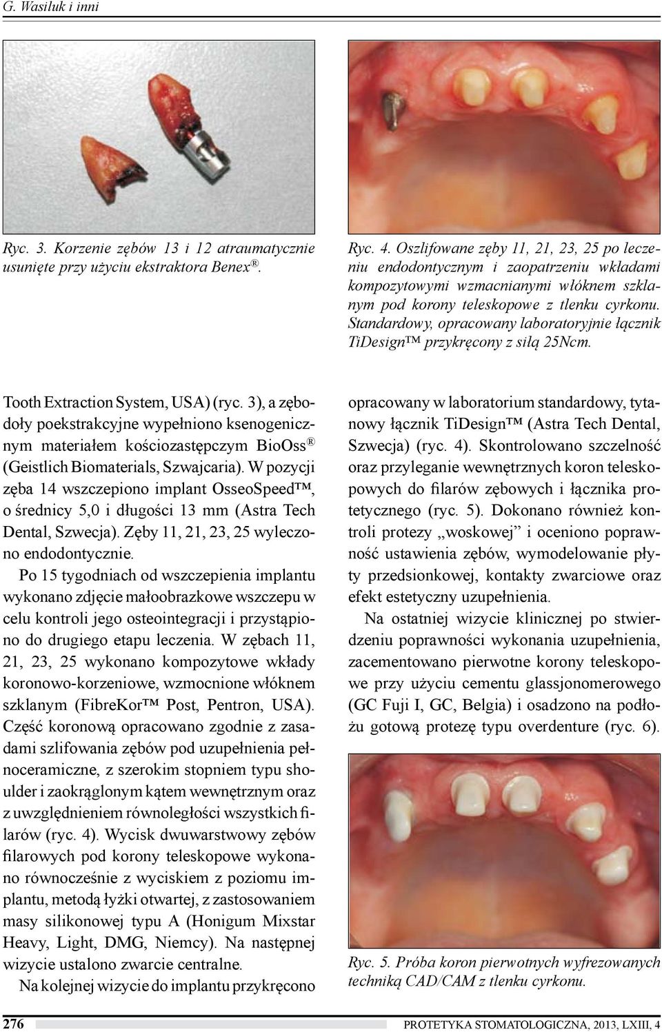 Standardowy, opracowany laboratoryjnie łącznik TiDesign przykręcony z siłą 25Ncm. Tooth Extraction System, USA) (ryc.