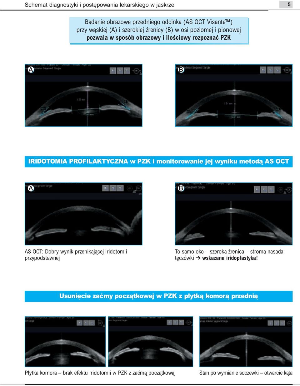 AS OCT A B AS OCT: Dobry wynik przenikajàcej iridotomii przypodstawnej To samo oko szeroka êrenica stroma nasada t czówki wskazana iridoplastyka!