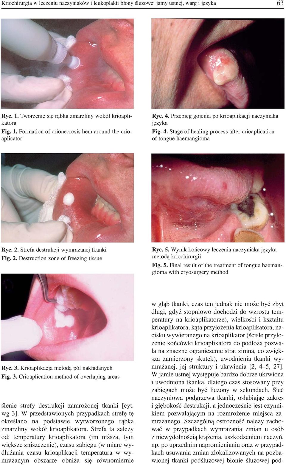 5. Wynik końcowy leczenia naczyniaka języka metodą kriochirurgii Fig. 5. Final result of the treatment of tongue haeman gioma with cryosurgery method Ryc. 3. Krioaplikacja metodą pól nakładanych Fig.