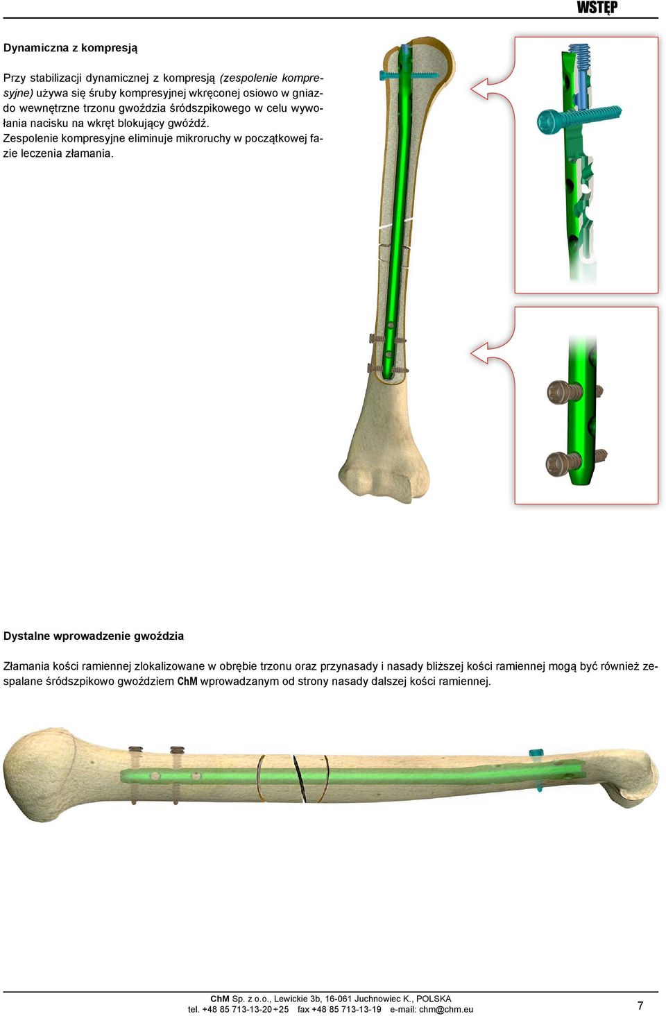 Zespolenie kompresyjne eliminuje mikroruchy w początkowej fazie leczenia złamania.