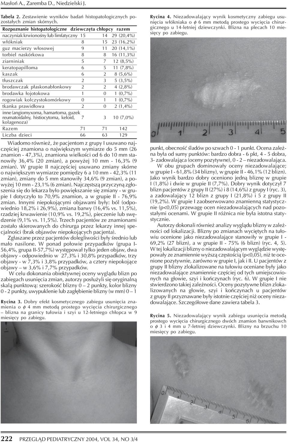 (11,3%) ziarniniak 5 7 12 (8,5%) keratopapilloma 6 5 11 (7,8%) kaszak 6 2 8 (5,6%) t³uszczak 2 3 5 (3,5%) brodawczak p³askonab³onkowy 2 2 4 (2,8%) brodawka ³ojotokowa 10 1(0,7%) rogowiak