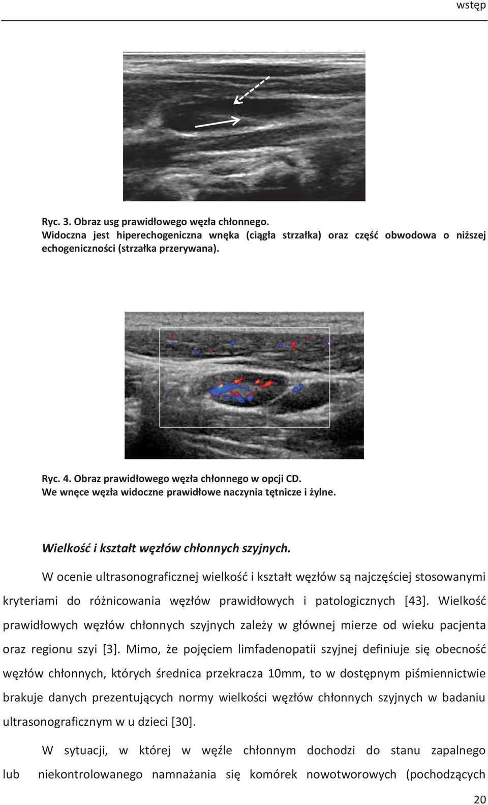 W ocenie ultrasonograficznej wielkość i kształt węzłów są najczęściej stosowanymi kryteriami do różnicowania węzłów prawidłowych i patologicznych [43].