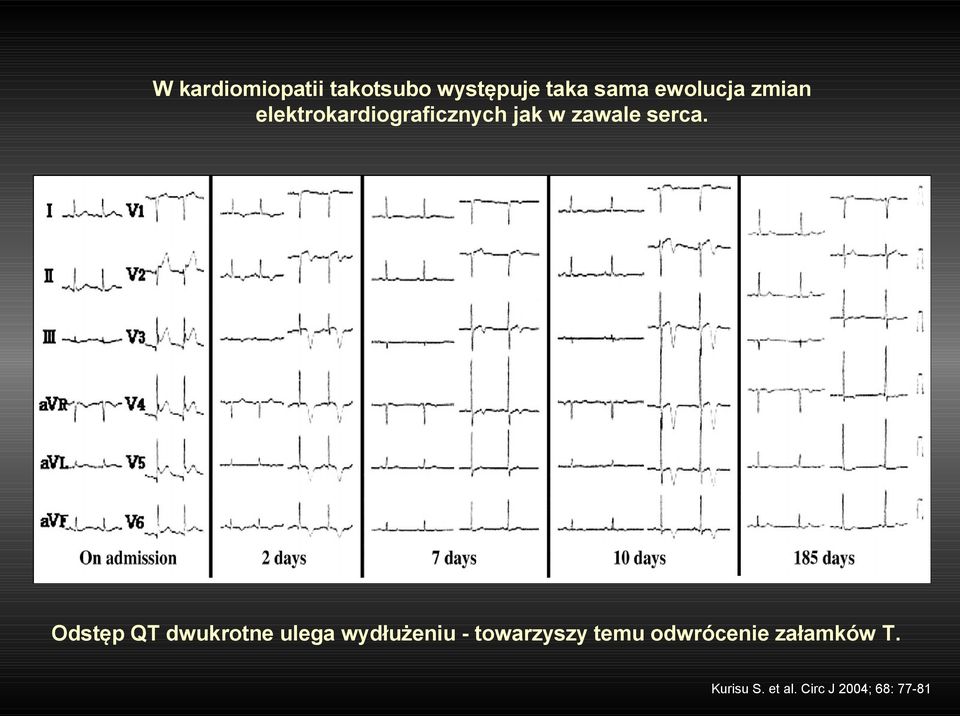 Odstęp QT dwukrotne ulega wydłużeniu - towarzyszy temu