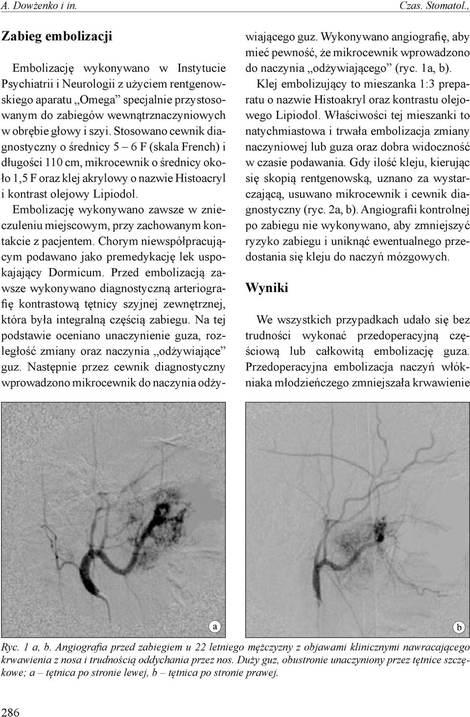 szyi. Stosowano cewnik diagnostyczny o średnicy 5 6 F (skala French) i długości 110 cm, mikrocewnik o średnicy około 1,5 F oraz klej akrylowy o nazwie Histoacryl i kontrast olejowy Lipiodol.