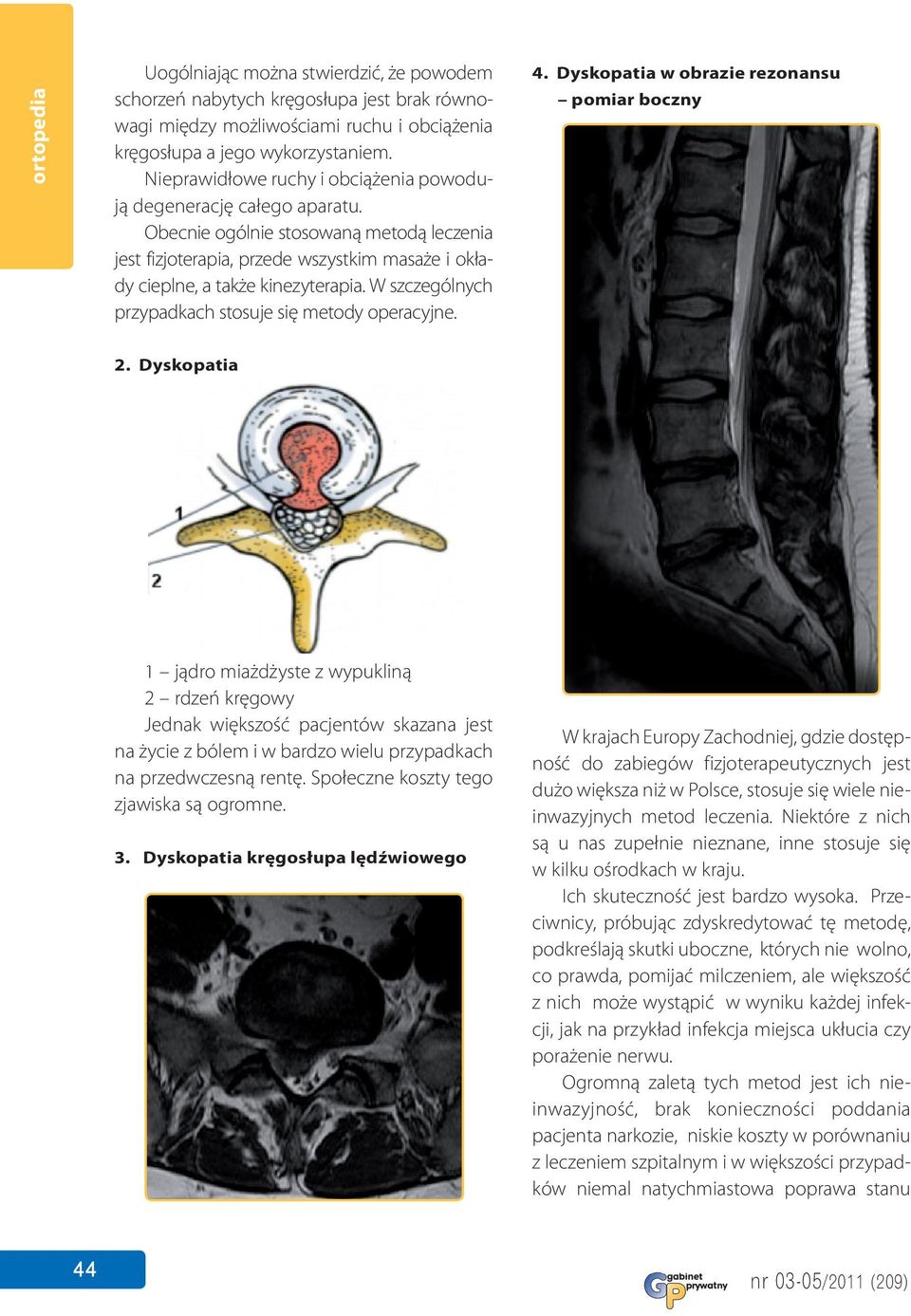 W szczególnych przypadkach stosuje się metody operacyjne. 4. Dyskopatia w obrazie rezonansu pomiar boczny 2.