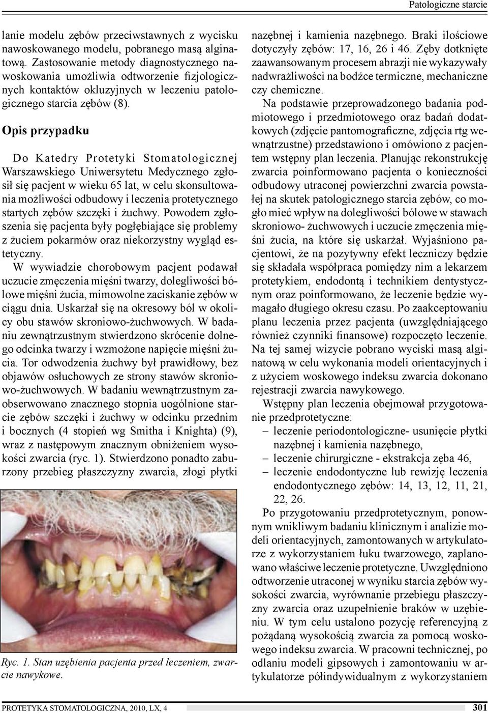 Opis przypadku Do Katedry Protetyki Stomatologicznej Warszawskiego Uniwersytetu Medycznego zgłosił się pacjent w wieku 65 lat, w celu skonsultowania możliwości odbudowy i leczenia protetycznego