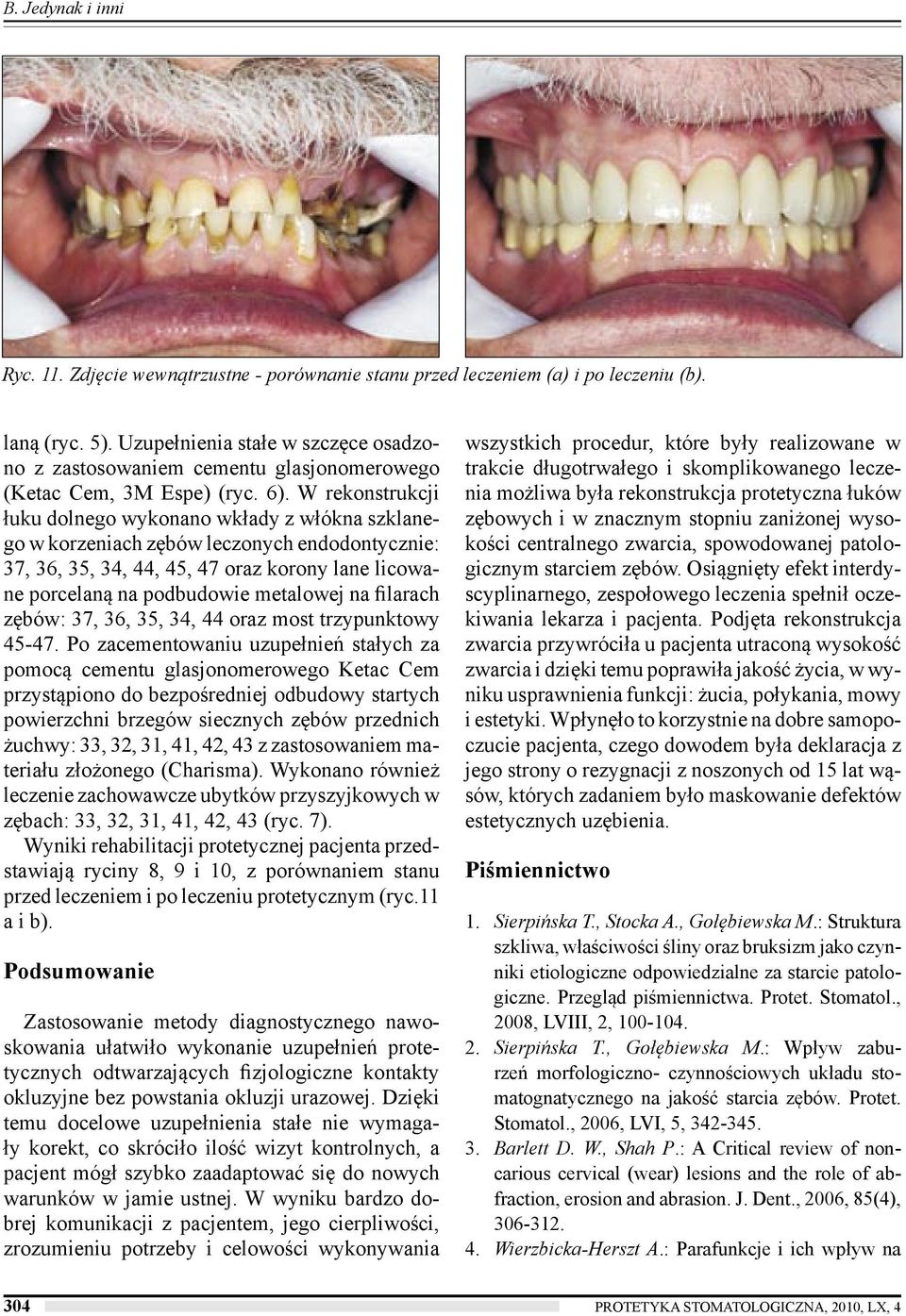 W rekonstrukcji łuku dolnego wykonano wkłady z włókna szklanego w korzeniach zębów leczonych endodontycznie: 37, 36, 35, 34, 44, 45, 47 oraz korony lane licowane porcelaną na podbudowie metalowej na