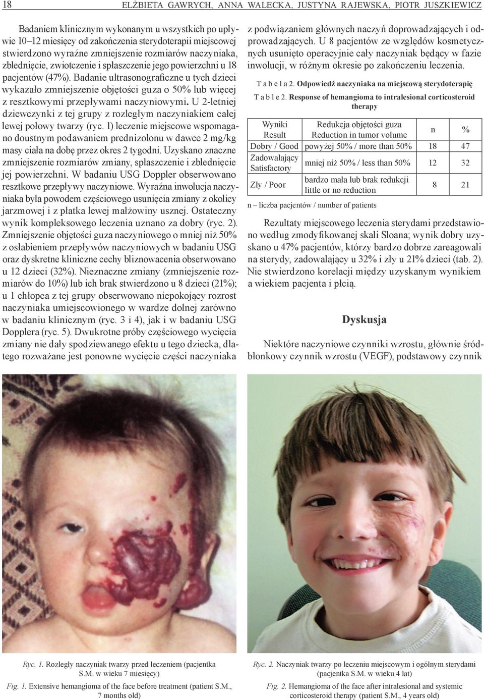 Badanie ultrasonograficzne u tych dzieci wykazało zmniejszenie objętości guza o 50% lub więcej z resztkowymi przepływami naczyniowymi.