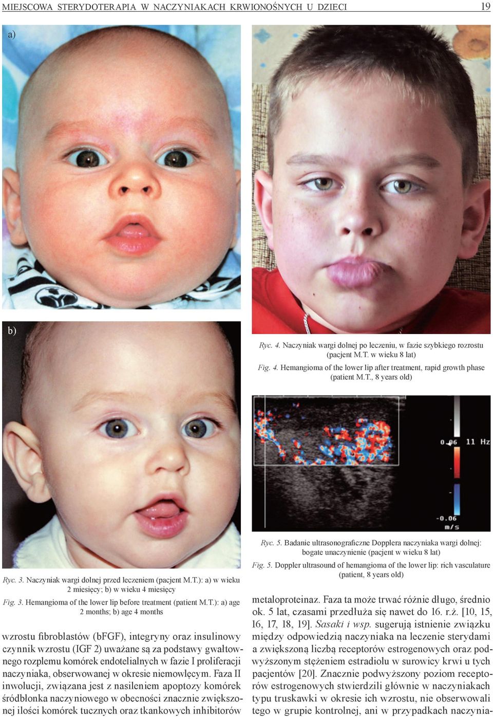 age 2 months; b) age 4 months wzrostu fibroblastów (bfgf), integryny oraz insulinowy czynnik wzrostu (IGF 2) uważane są za podstawy gwałtownego rozplemu komórek endotelialnych w fazie I proliferacji