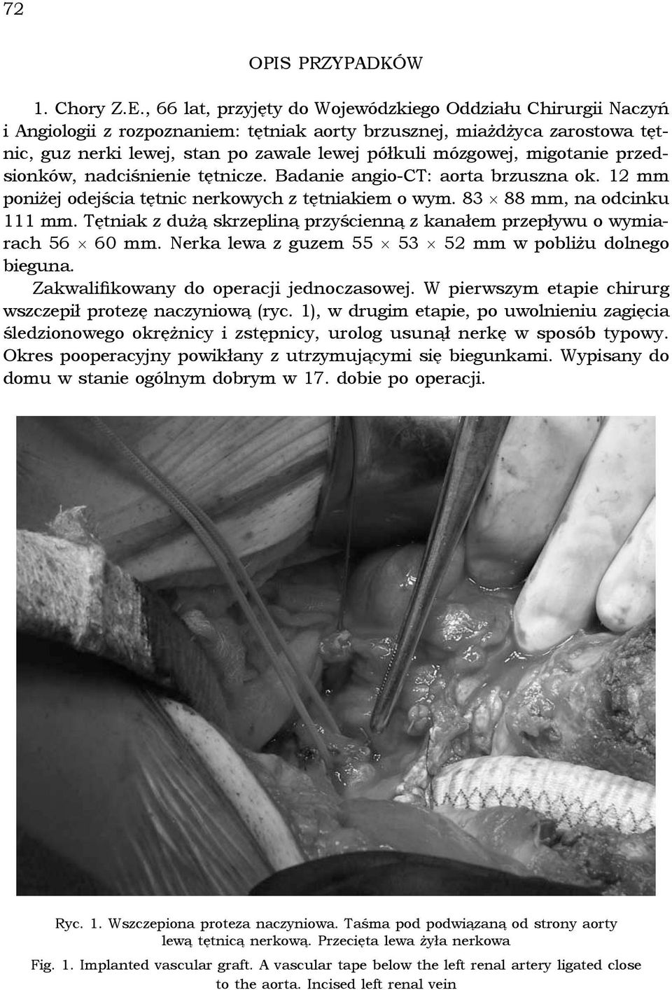 migotanie przedsionków, nadciśnienie tętnicze. Badanie angio-ct: aorta brzuszna ok. 12 mm poniżej odejścia tętnic nerkowych z tętniakiem o wym. 83 88 mm, na odcinku 111 mm.