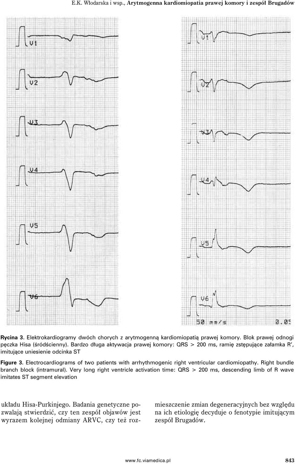 Electrocardiograms of two patients with arrhythmogenic right ventricular cardiomiopathy. Right bundle branch block (intramural).