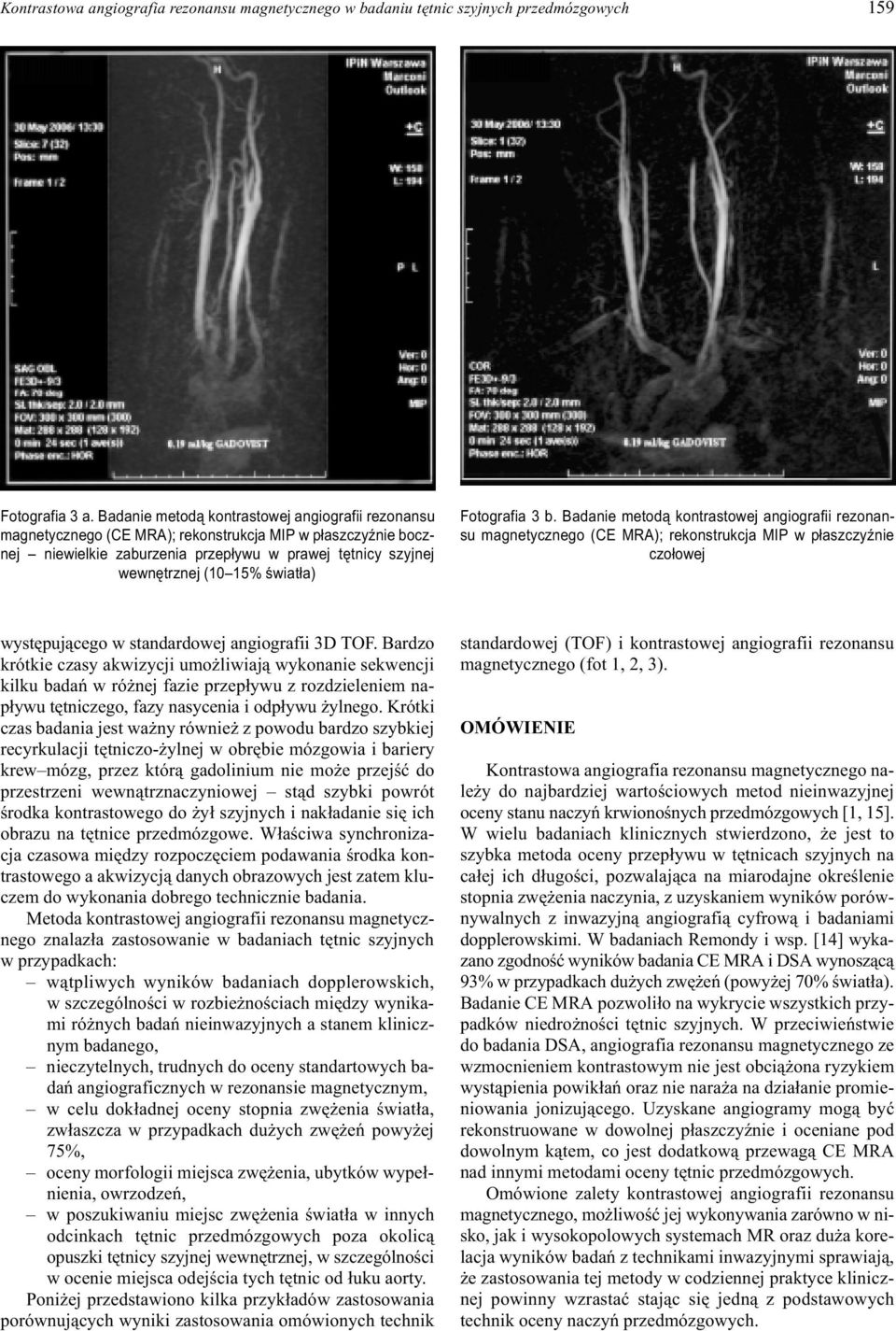 œwiat³a) Fotografia 3 b. Badanie metod¹ kontrastowej angiografii rezonansu magnetycznego (CE MRA); rekonstrukcja MIP w p³aszczyÿnie czo³owej wystêpuj¹cego w standardowej angiografii 3D TOF.